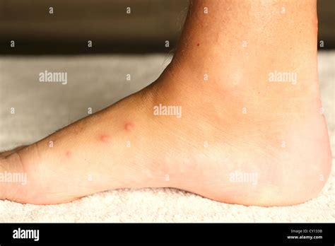 Bed Bug Bites On A Mans Foot Stock Photo Alamy