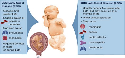 Frontiers Bacterial And Host Determinants Of Group B Streptococcal