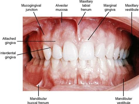 Fig 1 2 View Of Vestibule A Change In Color At The Mucogingival