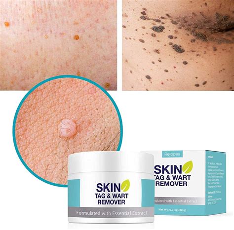 Buy Skin Tag Remover Warts Mole Remover Cream Skin Tags Dry And