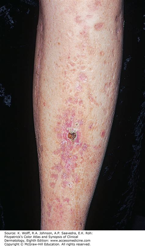 Skin Lesion Icd 10 - NaturalSkins