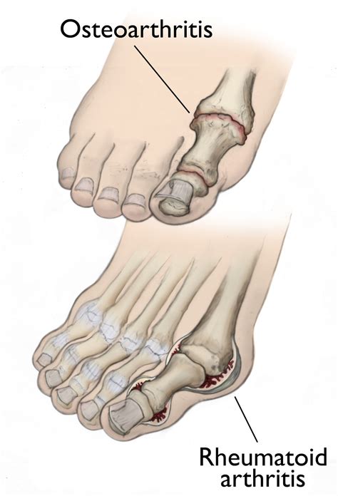 How Arthritis Affects The Feet