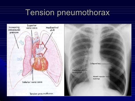 Copd Basic Pathophysiology Perokok Z