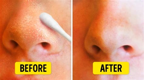 9 Natural Ways To Get Rid Of Blackheads On Nose Youtube