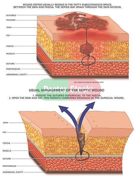 Septic Surgical Wound Management Doctor Stock