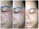 Photos of Makeup Allergy