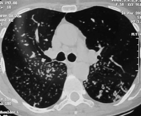 The High Resolution Computed Tomography Scan Of The Chest Hrct