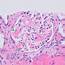 Kidney Biopsy Of The Month Amyloidosis  Renal Fellow Network