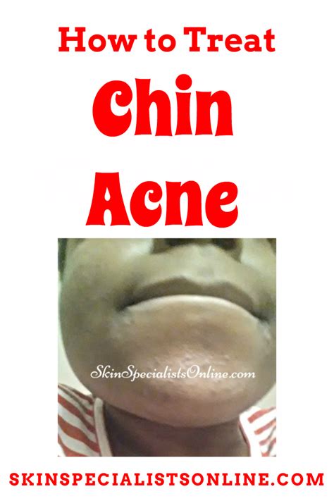 How To Treat Chin Acne Chin Acne Acne Skin Specialist