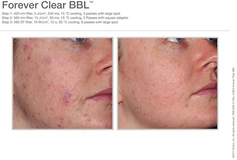 Forever Clear Bbl For Acne Forever Young Edmonton