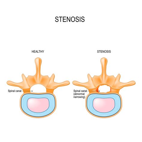 Managing Lumbar Spinal Stenosis Atlanta Brain And Spine Care