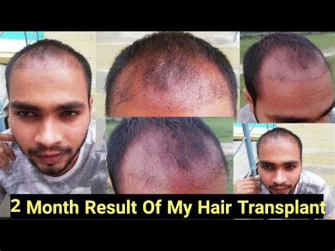 Hair Transplant Result In Month Days Of Hair Transplant Ganesh Thakur YouTube