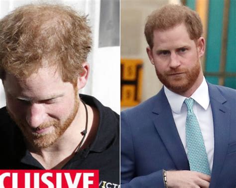 Prince Harry's Hair Transplant