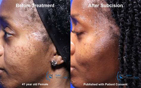Black People Acne Scars Before And After