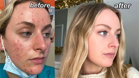MY ACCUTANE JOURNEY My Acne Experience Q A Tips Pictures YouTube