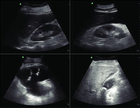Example Images Seen During Abdominal Ultrasound Clockwise From Top
