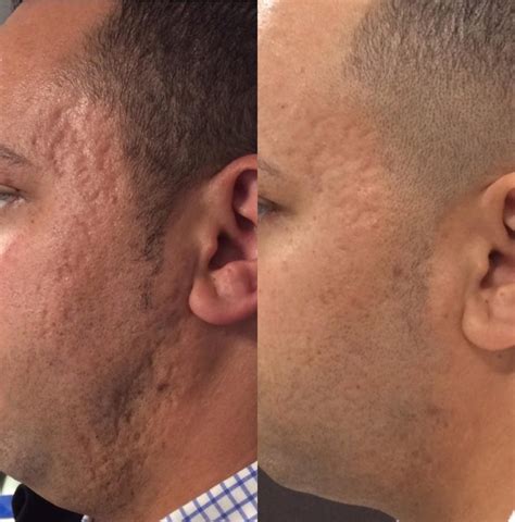Microneedling Before And After Photo Gallery Sacramento Ca Destination Aesthetics
