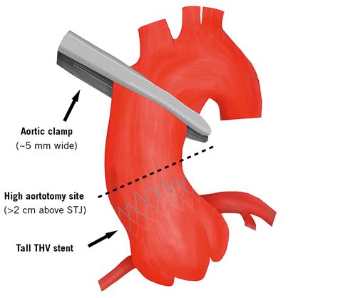Surgical Feasibility Of Ascending Aorta Manipulation After