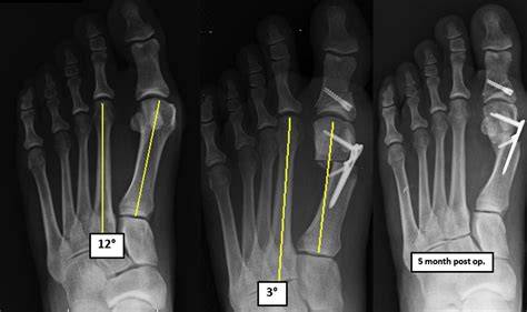 Correction Of Moderate And Severe Hallux Valgus Deformity With A Distal