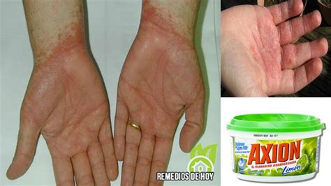 Dermatitis Alérgia Por Jabones Tratamiento Alergias Dermatitis De