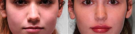 Lip Augmentation Photos Chevy Chase Md Patient 15005
