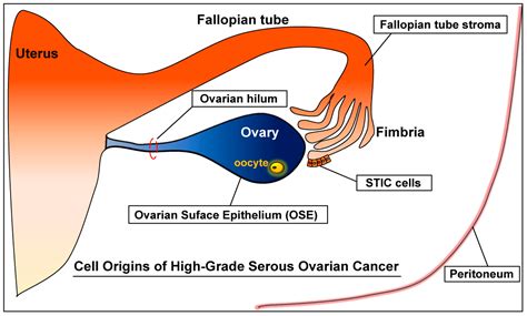 Cancers Free Full Text Cell Origins Of High Grade Serous Ovarian Cancer