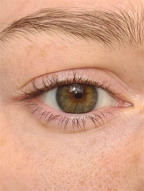 Always Say I Have Hazel Eyes Because Explaining Central Heterochromia