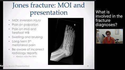 5th Metatarsal Fractures Treatment And Diagnosis Youtube
