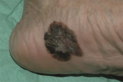 Melanoma Oc Foot And Ankle Clinic
