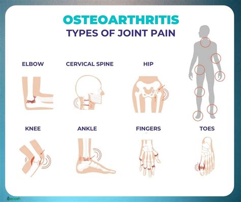 Osteoarthritis Oa Symptoms Causes Risk Groups Prevention And