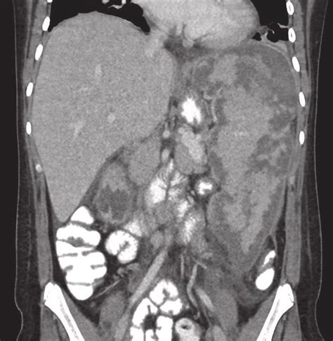 Coronal Section Of Ct Abdomen With Contrast Showing Massive