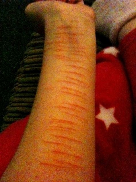 What It Looks Like Self Harm Is Not At All Ok