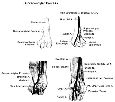 Image Of Supracondylar Process Ligament Of Struthers And The Brachial
