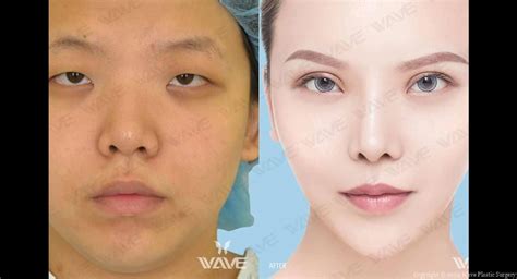 Asian Double Eyelid Plastic Surgery In Los Angeles Wave