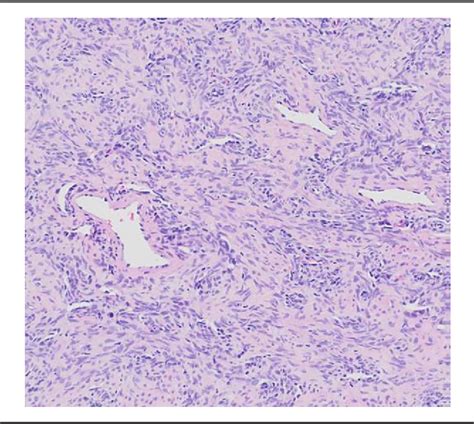 Figure 1 From Solitary Fibrous Tumor Of Hard Palate A Case Report And