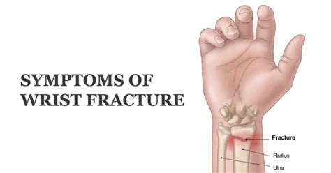 Symptoms Of Wrist Fracture Welcome To Sys Medtech International Pvt Ltd