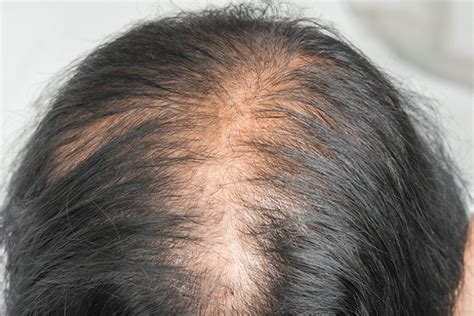 Top 7 Early Signs Of Hair Baldness And Protective Measures Keep
