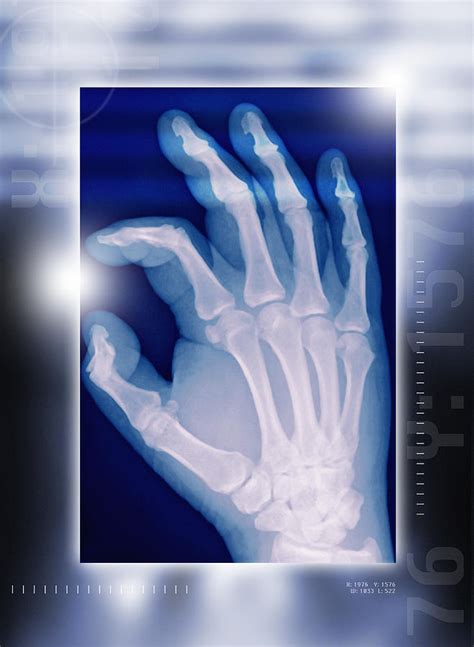 Healthy Hand X Ray Photograph By Miriam Maslo Fine Art America