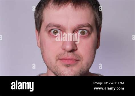 A Pop Eyed Man With Graves Disease Toxic Diffuse Goiter