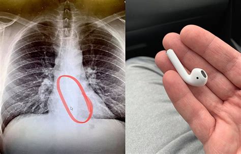 New England Man Swallowed An Airpod In His Sleep And Survived