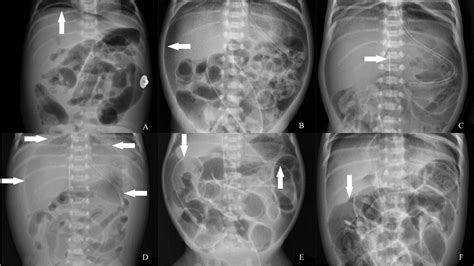 Specific Imaging Features Of Intestinal Perforation On Supine Abdominal