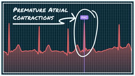 What Premature Atrial Contraction Pac Looks Like On Your Watch Ecg Qaly