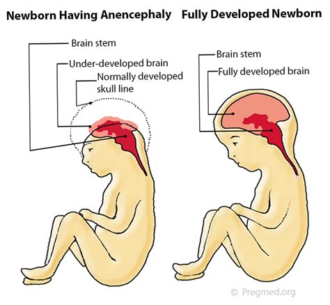 Anencephaly Pictures 1 Fetal Health Foundation