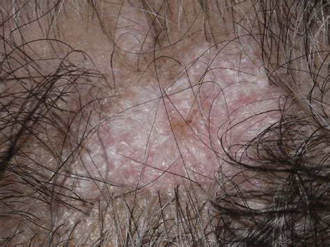 Scarring Alopecia Due To Burnt Out Discoid Lupus Erythematosus Note