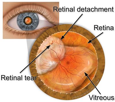 It's often accompanied by the sudden onset of symptoms such as floaters and flashing lights. Retina Health Center Retinal Tear and Detachment