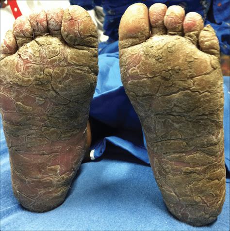 Photograph Of The Feet Revealing Thick Hyperkeratotic Plaques With