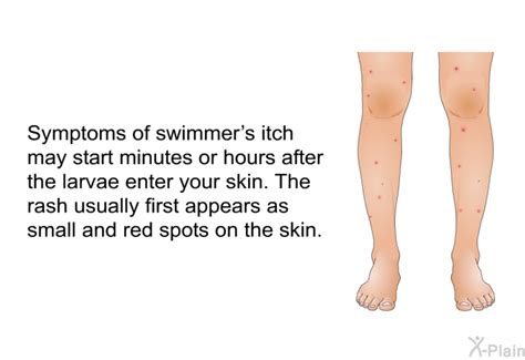 Swimmers Itch
