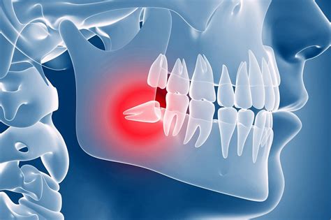 Wisdom Teeth Removal 5 Awesome Tips For Recovery Elite Dental Care