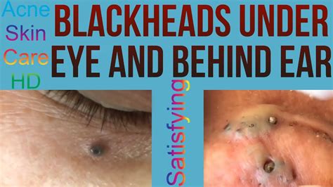 Blackheads Under Eye And Behind Ear Extraction Acne Skincare Ep11
