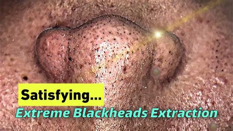 Extreme Blackheads Removal Satisfying Asian Skin 29 Years Old